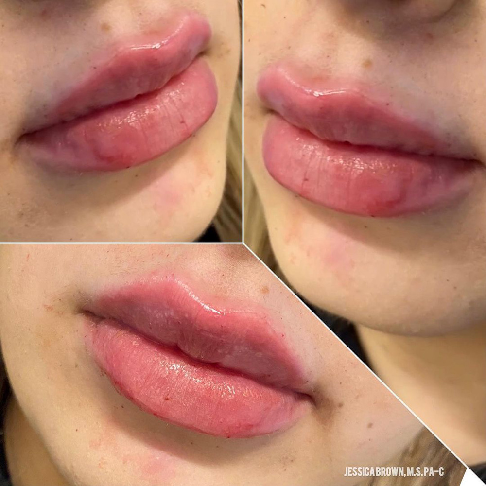 Real patient Lip Augmentation by ECA Plastic Surgery, New Jersey