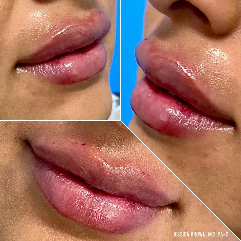 Real patient Lip Augmentation by ECA Plastic Surgery, New Jersey