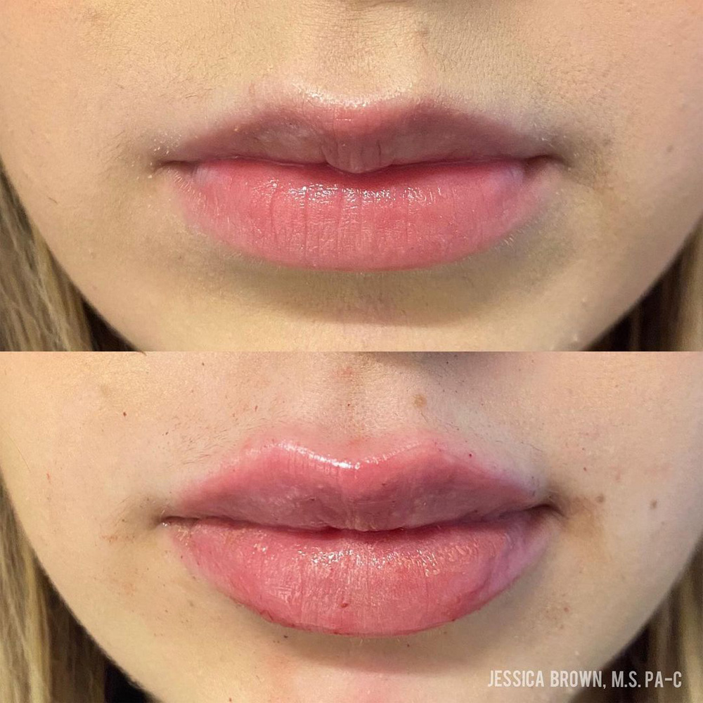 Real patient Lip Augmentation by ECA Plastic Surgery, New Jersey