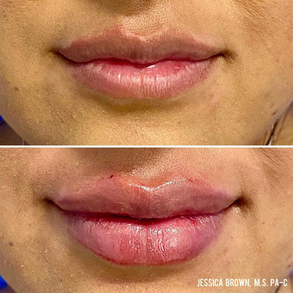 Real patient Lip Augmentation by ECA Plastic Surgery, New Jersey