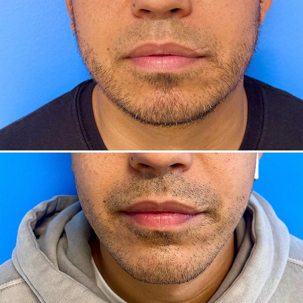 Real patient Lip Augmentation by ECA Plastic Surgery, New Jersey