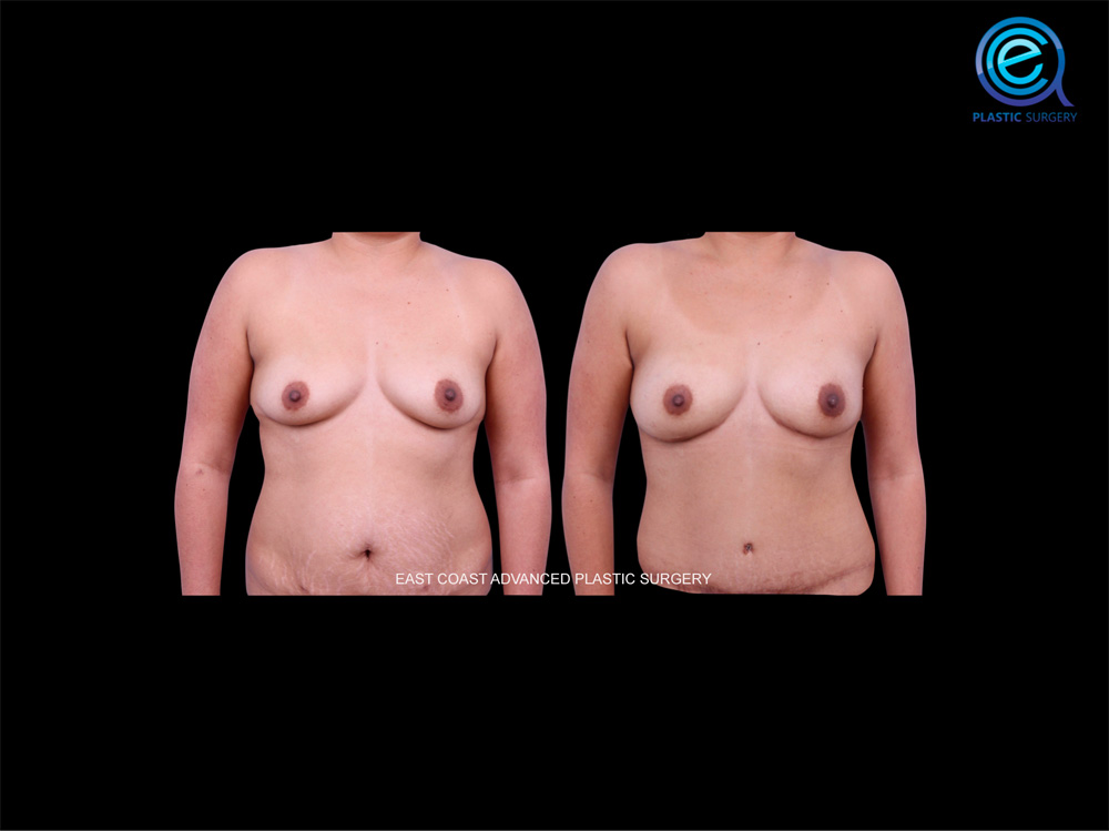 Real patient Breast Reconstruction by ECA Plastic Surgery, New Jersey