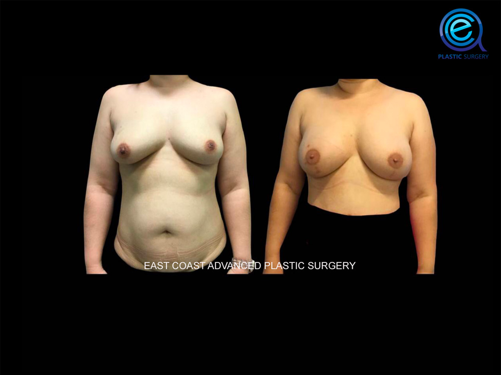 Real patient Breast Reconstruction by ECA Plastic Surgery, New Jersey