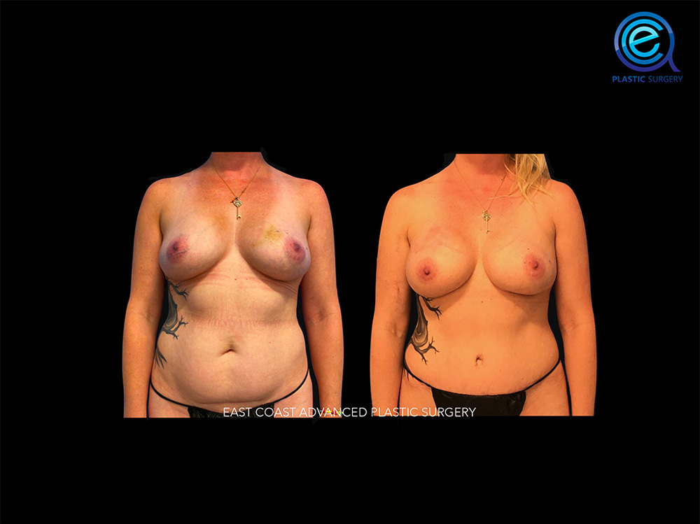 Real patient Breast Reconstruction by ECA Plastic Surgery, New Jersey