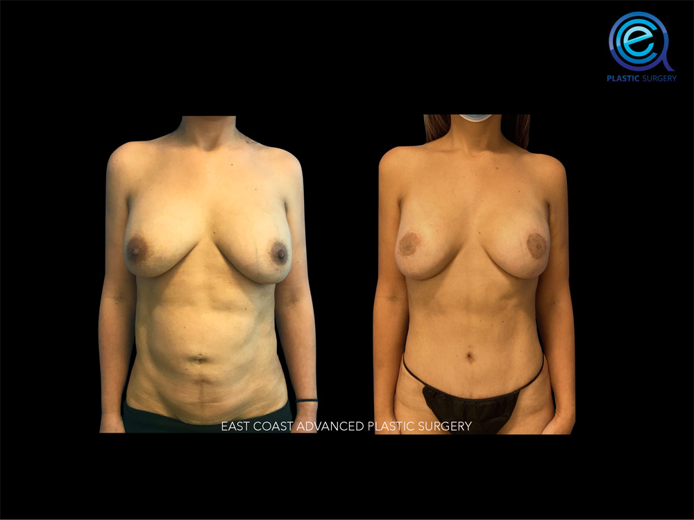 Real patient Breast Reconstruction by ECA Plastic Surgery, New Jersey
