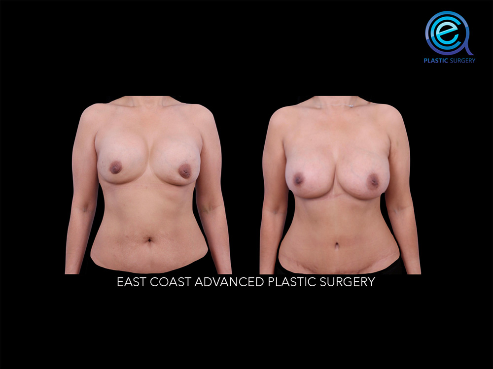 Real patient Breast Reconstruction by ECA Plastic Surgery, New Jersey