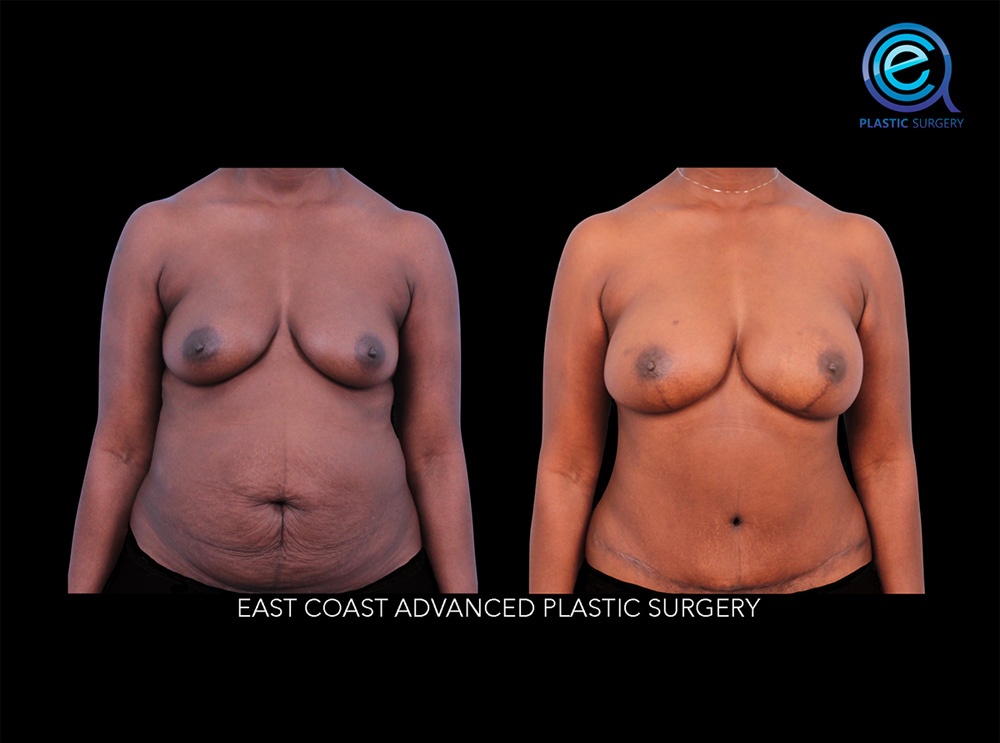 Real patient Breast Reconstruction by ECA Plastic Surgery, New Jersey