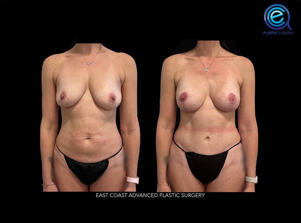 Real patient Breast Reconstruction by ECA Plastic Surgery, New Jersey