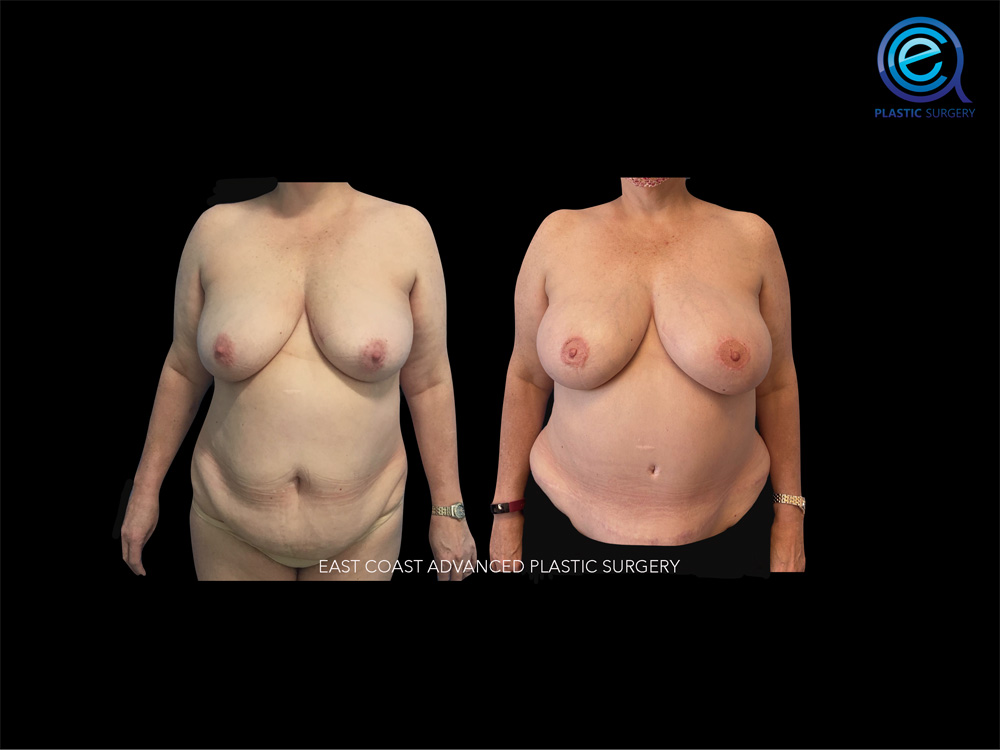 Real patient Breast Reconstruction by ECA Plastic Surgery, New Jersey