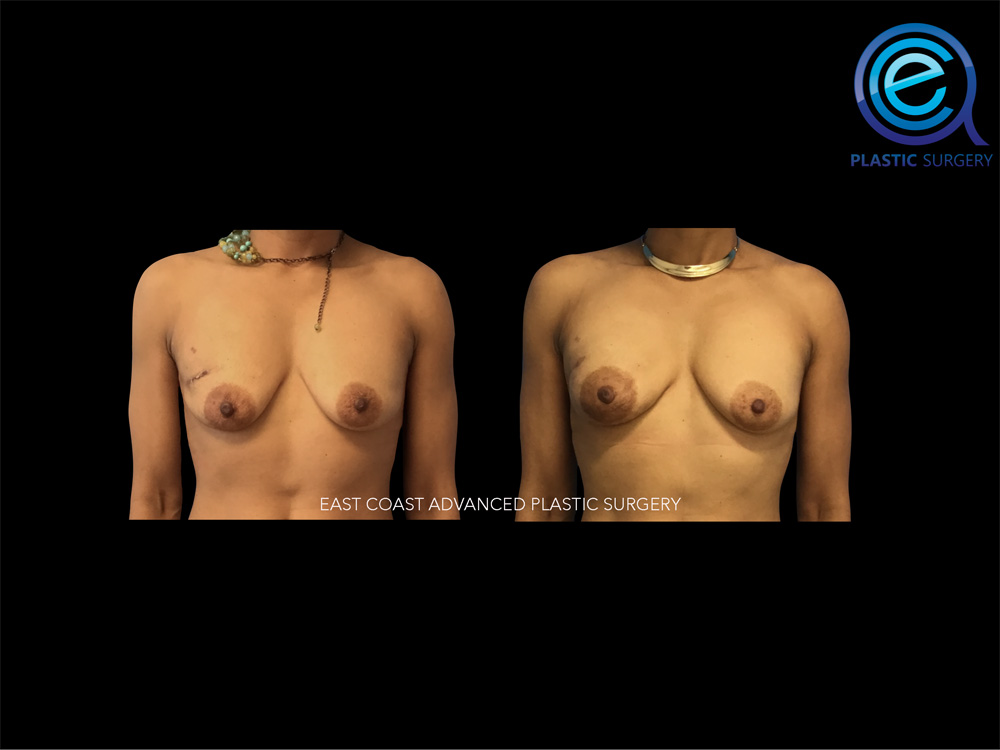Real patient Breast Reconstruction by ECA Plastic Surgery, New Jersey