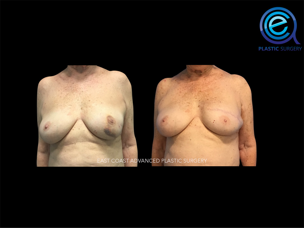 Real patient Breast Reconstruction by ECA Plastic Surgery, New Jersey