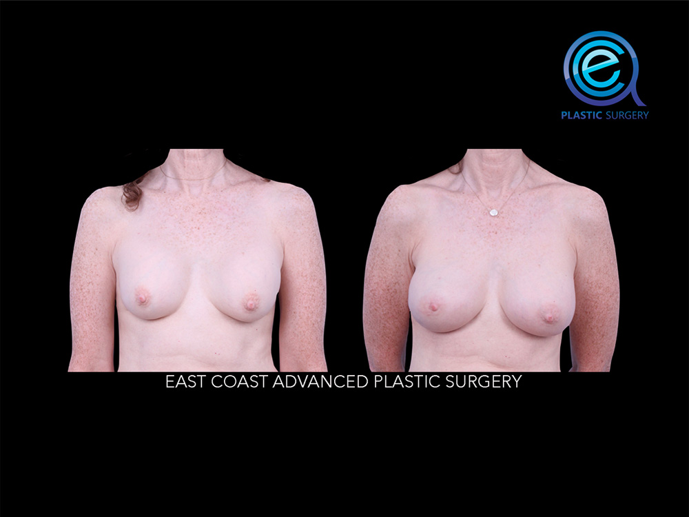 Real patient Breast Reconstruction by ECA Plastic Surgery, New Jersey