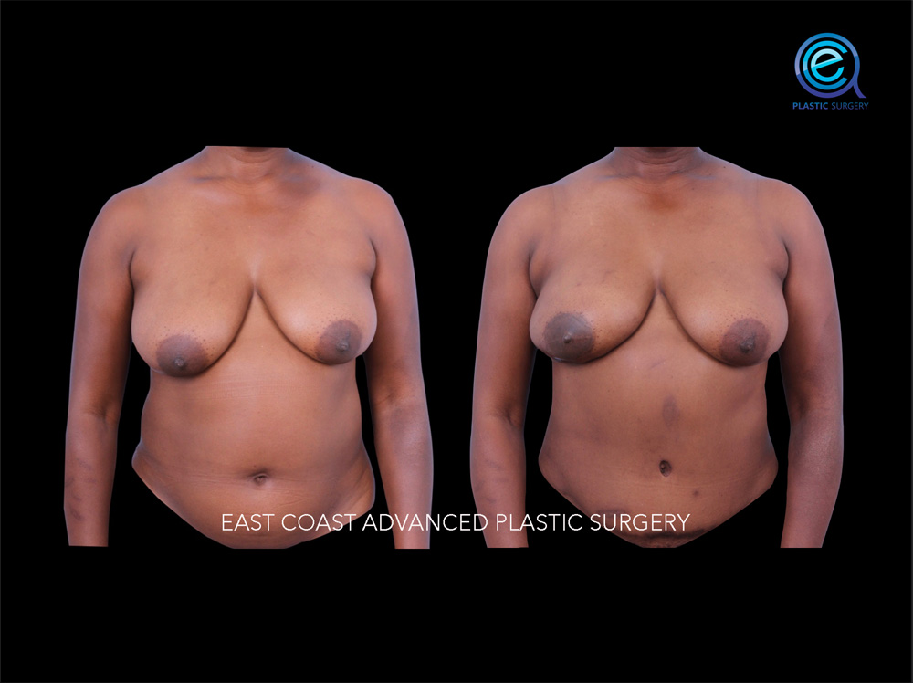 Real patient Breast Reconstruction by ECA Plastic Surgery, New Jersey
