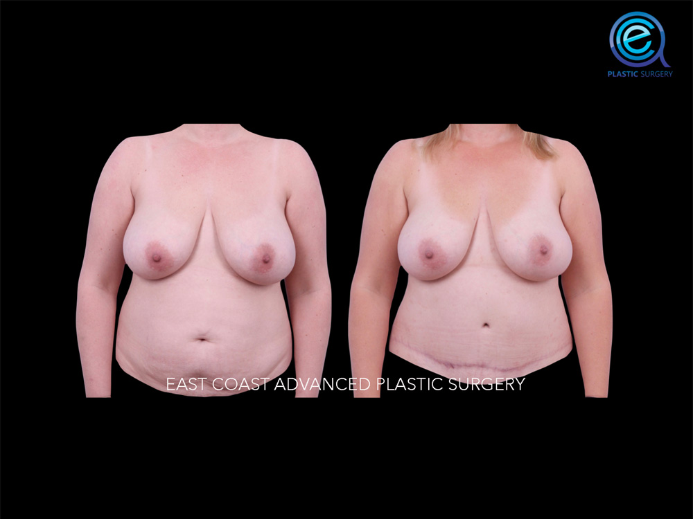 Real patient Breast Reconstruction by ECA Plastic Surgery, New Jersey