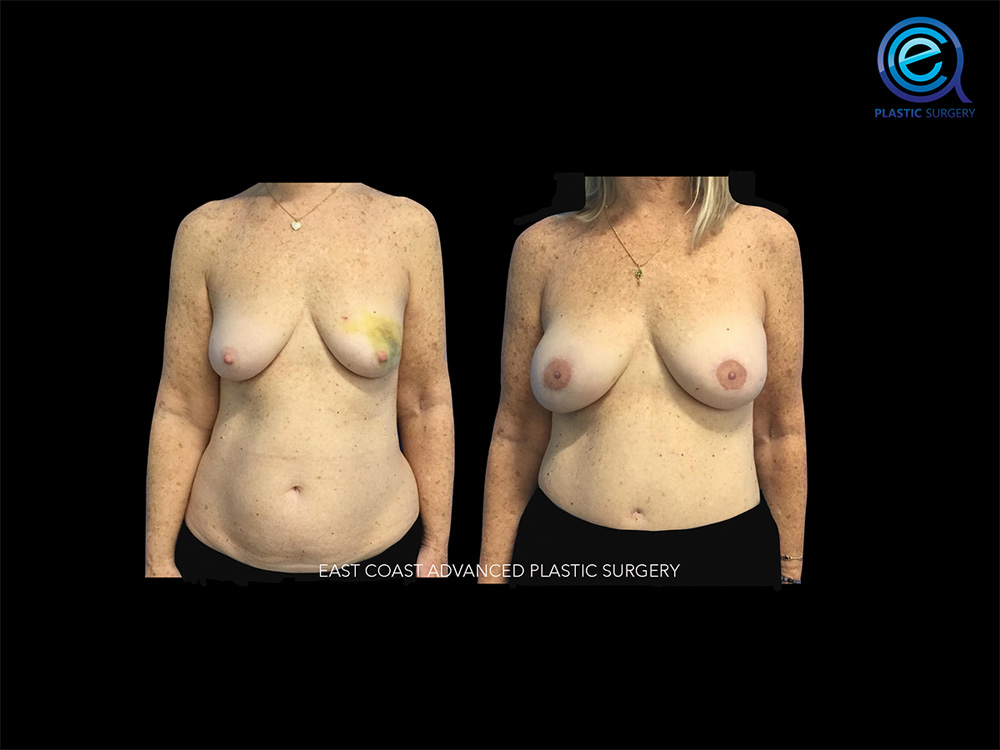 Real patient Breast Reconstruction by ECA Plastic Surgery, New Jersey