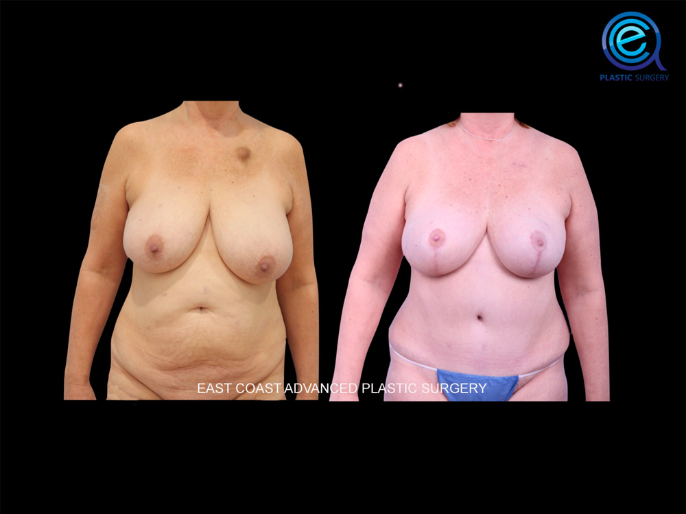 Real patient Breast Reconstruction by ECA Plastic Surgery, New Jersey