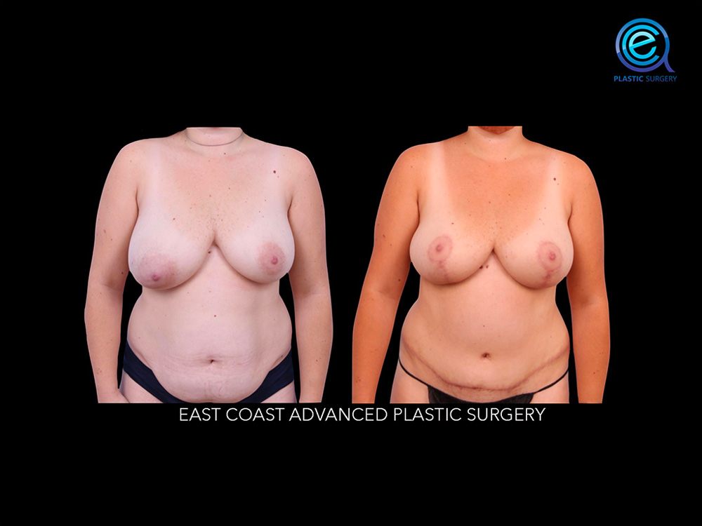 Real patient Breast Reconstruction by ECA Plastic Surgery, New Jersey