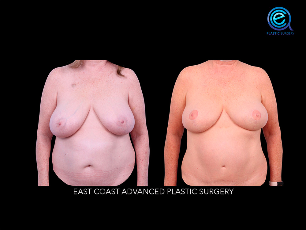 Real patient Breast Reconstruction by ECA Plastic Surgery, New Jersey