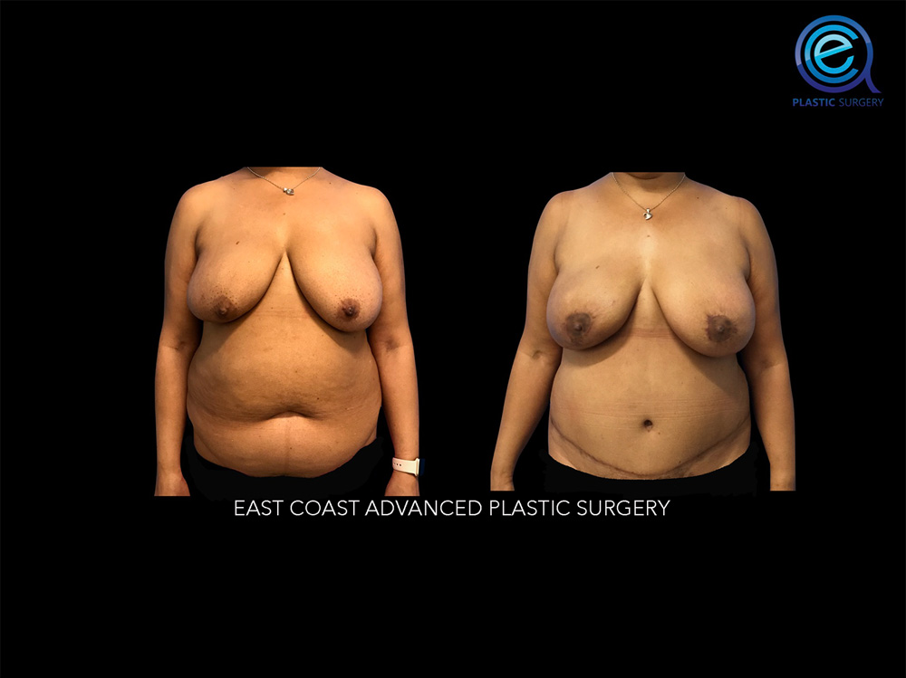 Real patient Breast Reconstruction by ECA Plastic Surgery, New Jersey