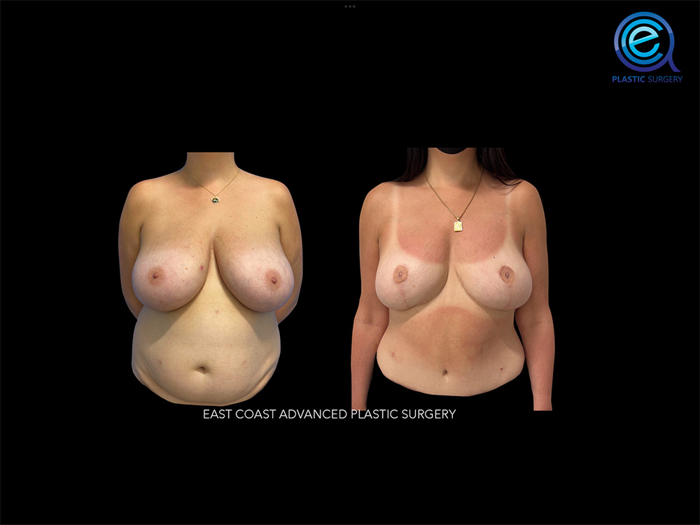 Real patient Breast Reconstruction by ECA Plastic Surgery, New Jersey