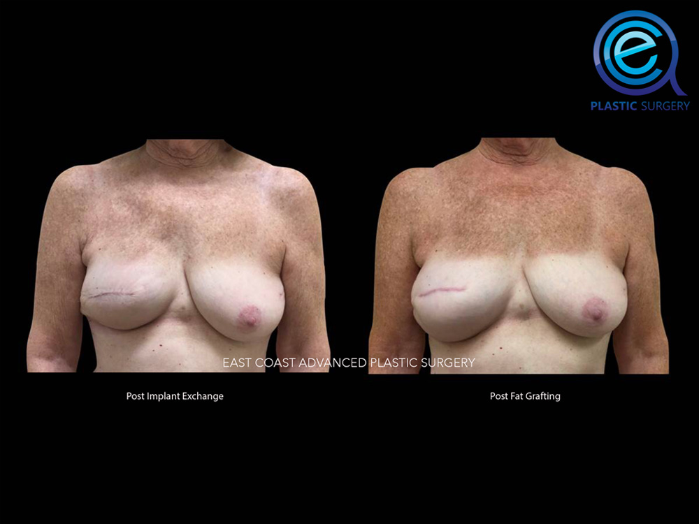 Real patient Breast Reconstruction by ECA Plastic Surgery, New Jersey