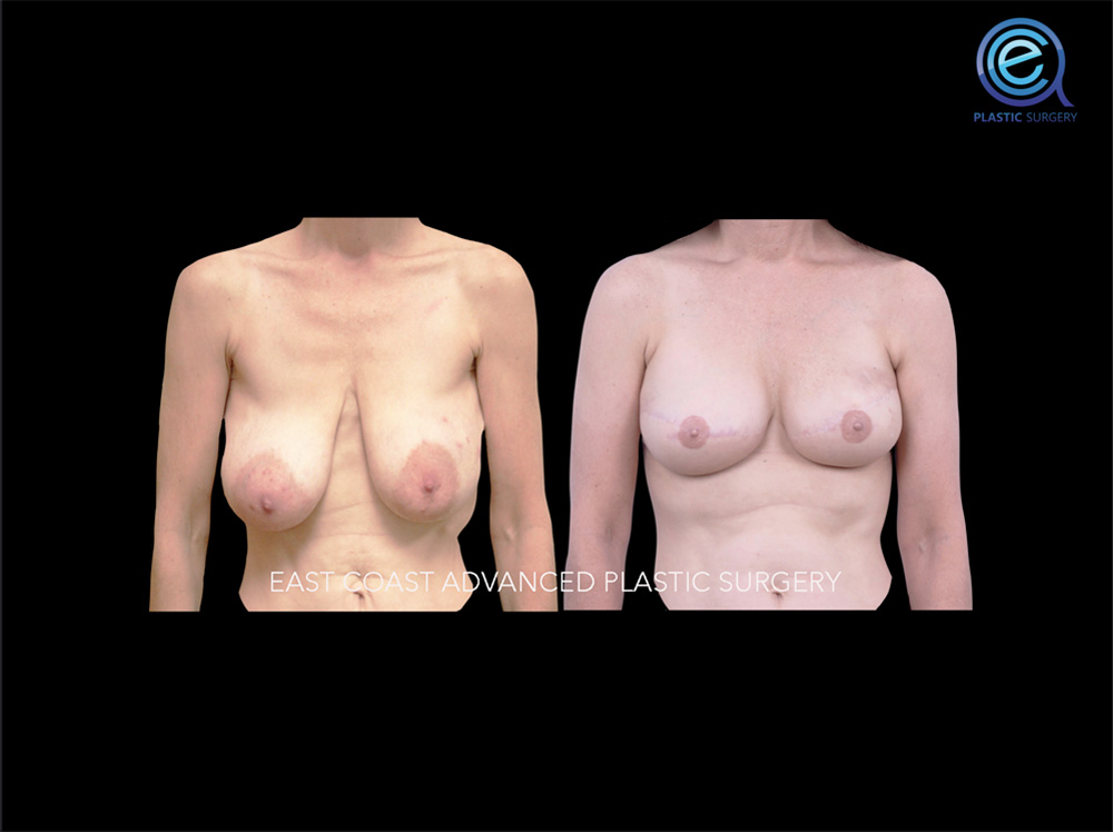 Real patient Breast Reconstruction by ECA Plastic Surgery, New Jersey