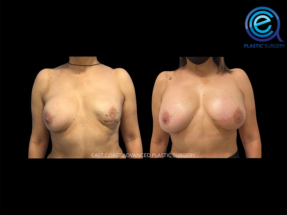 Real patient Breast Reconstruction by ECA Plastic Surgery, New Jersey