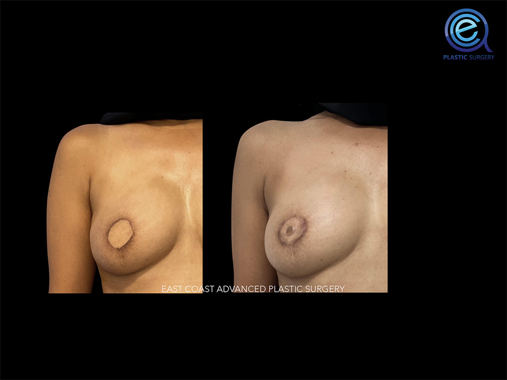 Real patient Breast Reconstruction by ECA Plastic Surgery, New Jersey