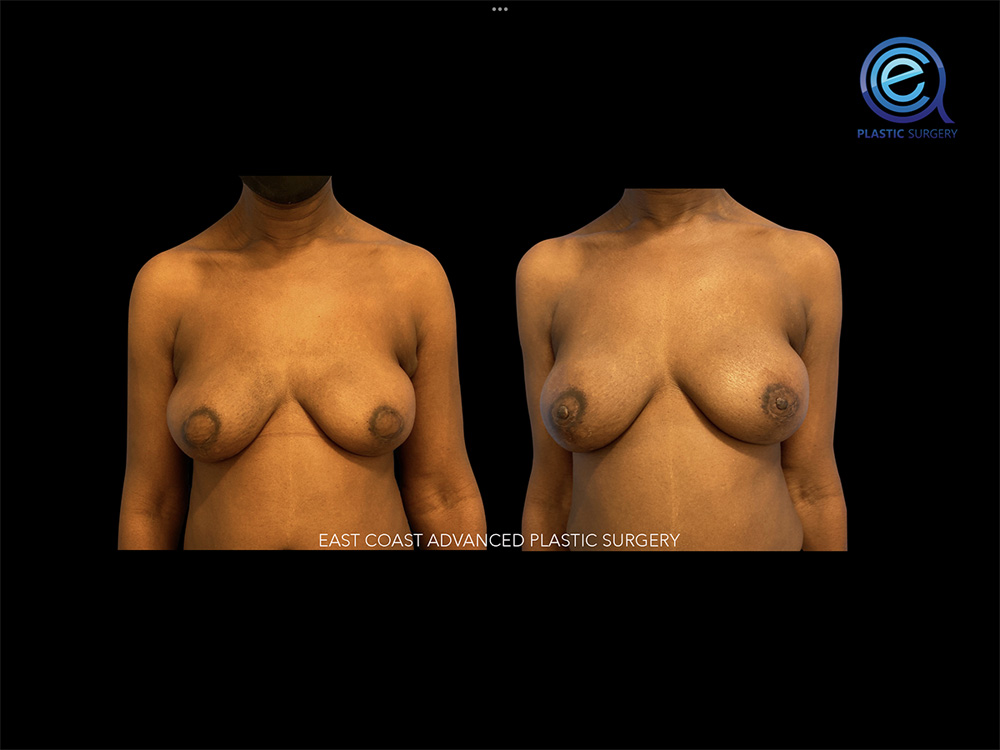 Real patient Breast Reconstruction by ECA Plastic Surgery, New Jersey
