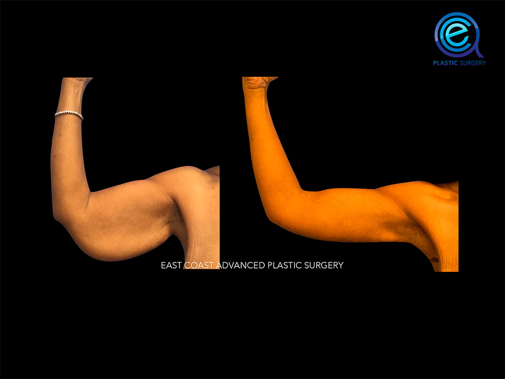 Real patient Brachioplasty Arm Lift by ECA Plastic Surgery, New Jersey