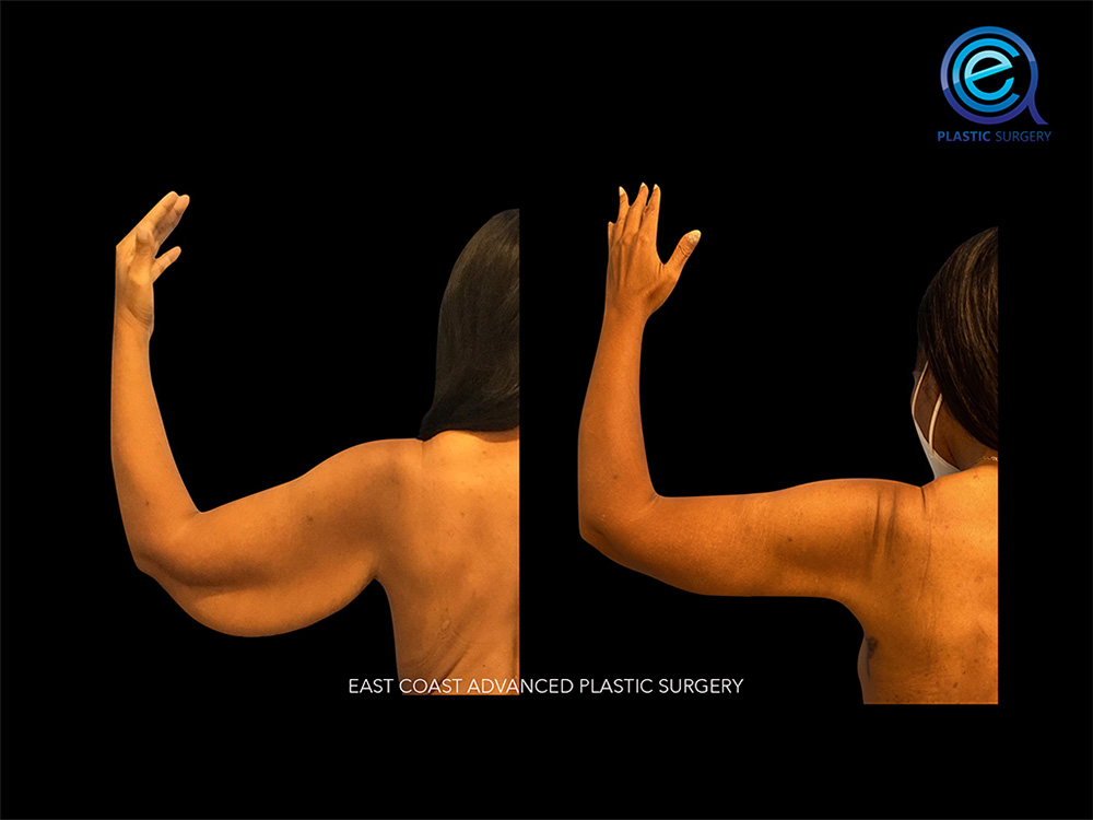 Real patient Brachioplasty Arm Lift by ECA Plastic Surgery, New Jersey