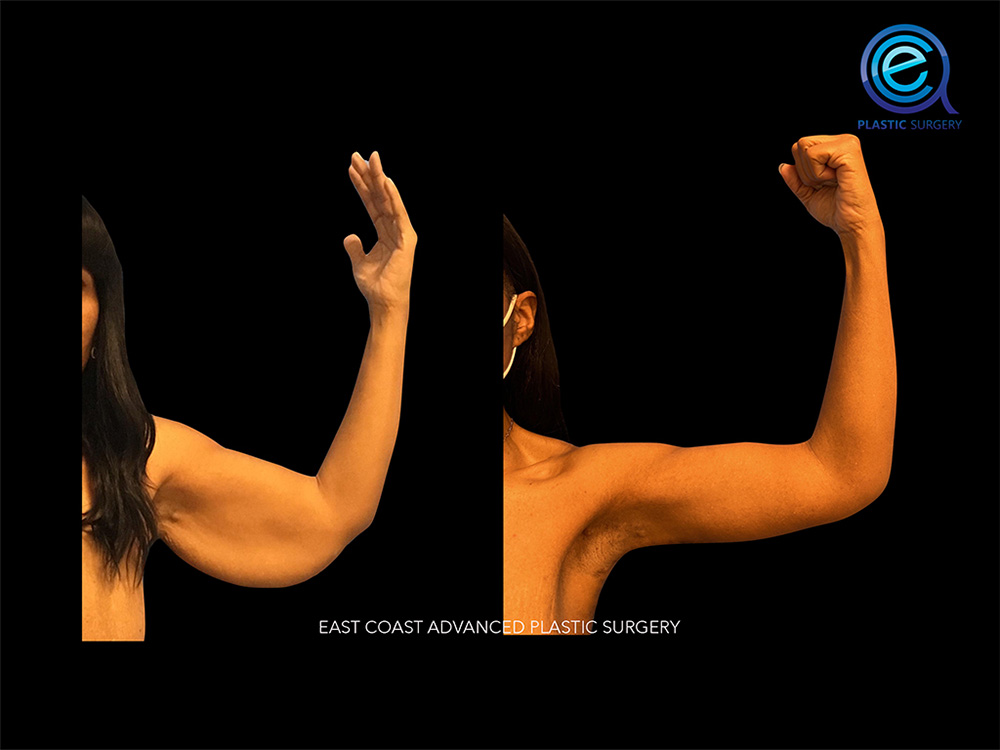 Real patient Brachioplasty Arm Lift by ECA Plastic Surgery, New Jersey