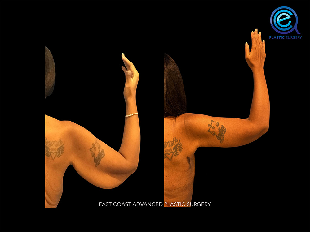 Real patient Brachioplasty Arm Lift by ECA Plastic Surgery, New Jersey