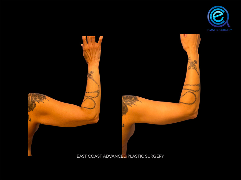 Real patient Brachioplasty Arm Lift by ECA Plastic Surgery, New Jersey