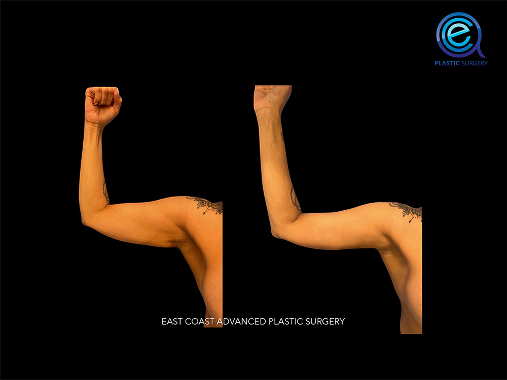 Real patient Brachioplasty Arm Lift by ECA Plastic Surgery, New Jersey