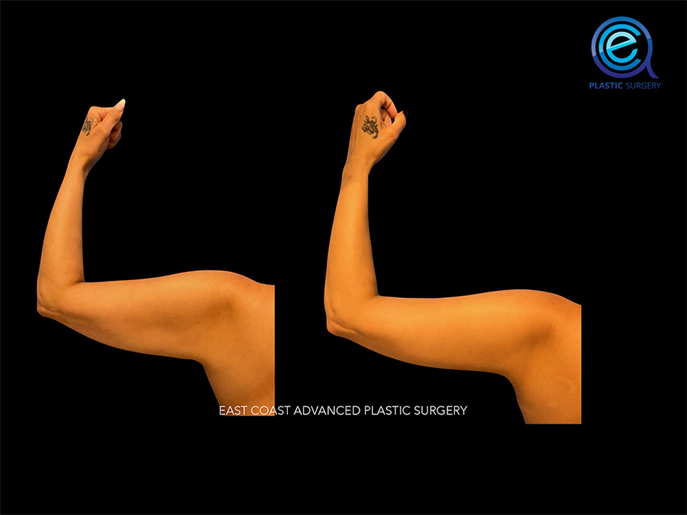 Real patient Brachioplasty Arm Lift by ECA Plastic Surgery, New Jersey