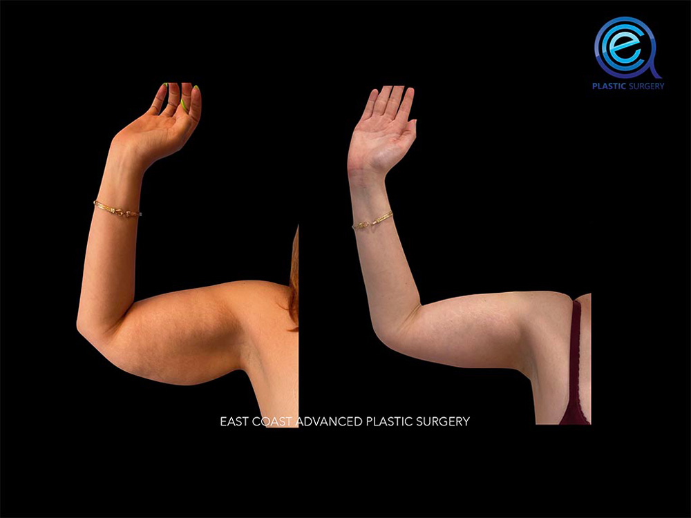Real patient Brachioplasty Arm Lift by ECA Plastic Surgery, New Jersey