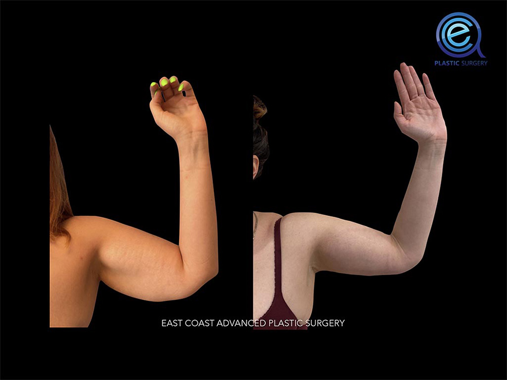 Real patient Brachioplasty Arm Lift by ECA Plastic Surgery, New Jersey