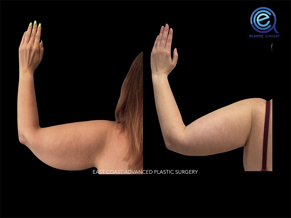 Real patient Brachioplasty Arm Lift by ECA Plastic Surgery, New Jersey