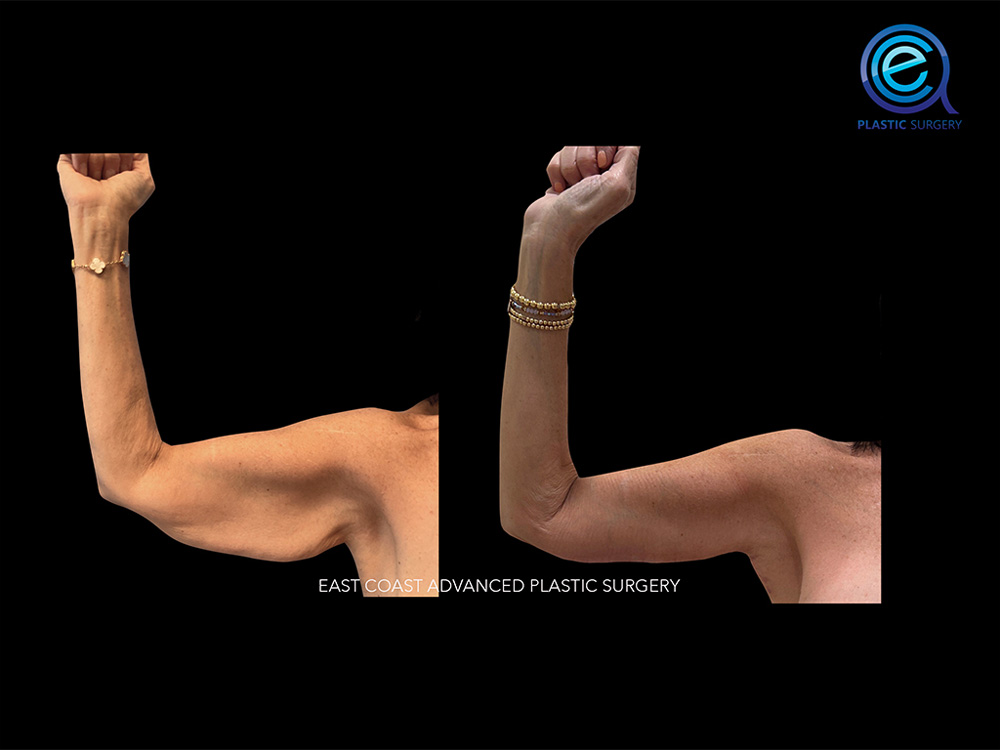 Real patient Brachioplasty Arm Lift by ECA Plastic Surgery, New Jersey