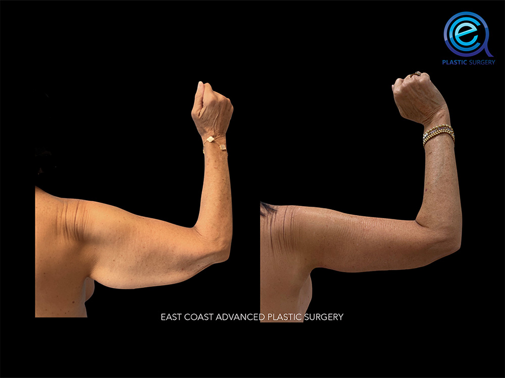 Real patient Brachioplasty Arm Lift by ECA Plastic Surgery, New Jersey