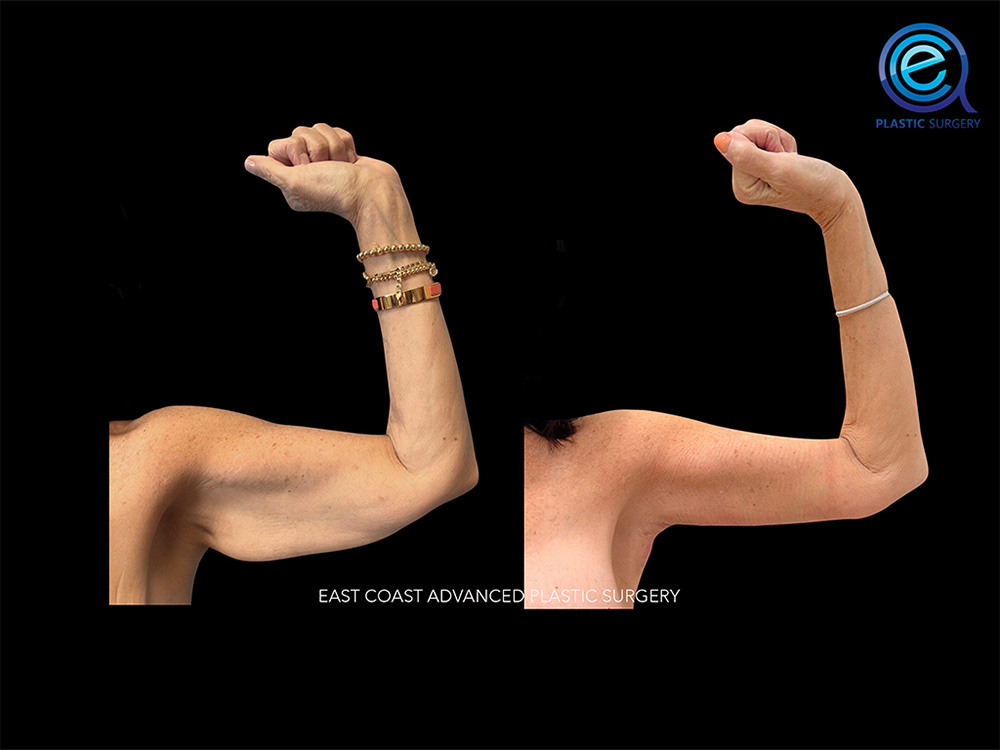 Real patient Brachioplasty Arm Lift by ECA Plastic Surgery, New Jersey