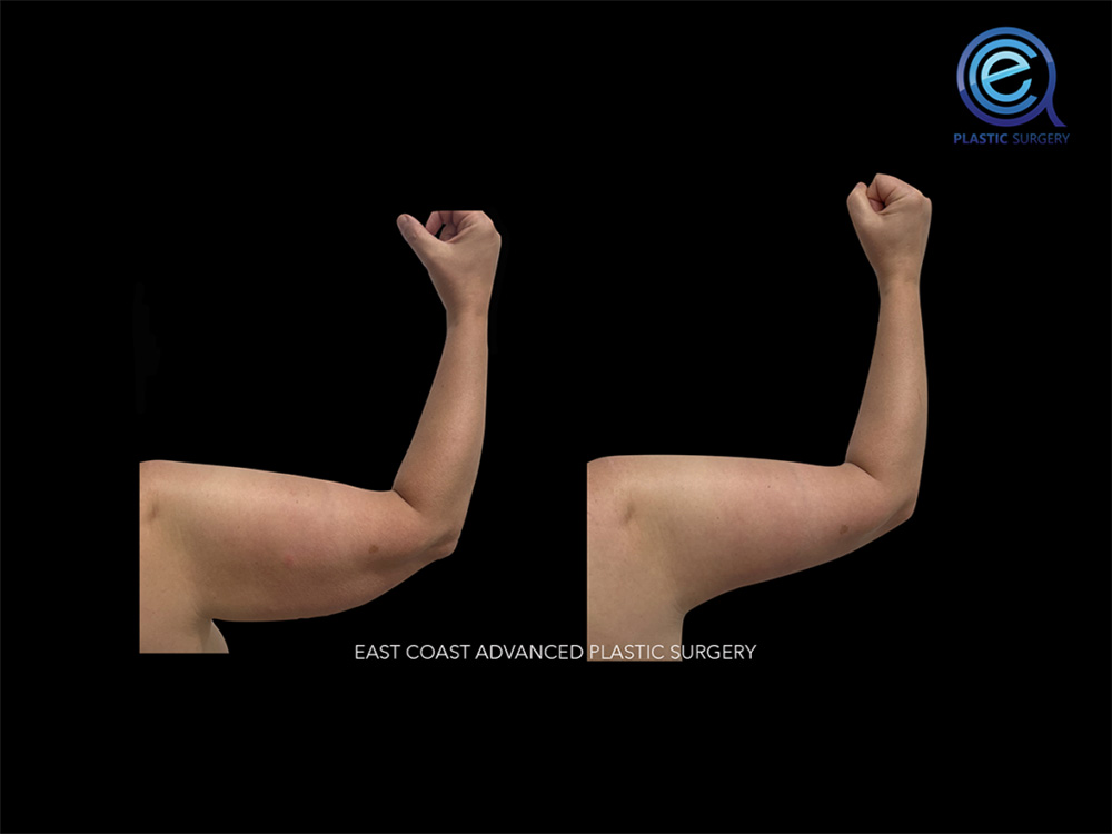Real patient Brachioplasty Arm Lift by ECA Plastic Surgery, New Jersey