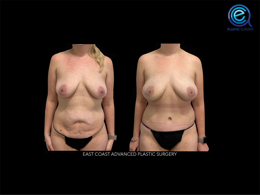 Real patient Breast Reconstruction by ECA Plastic Surgery, New Jersey