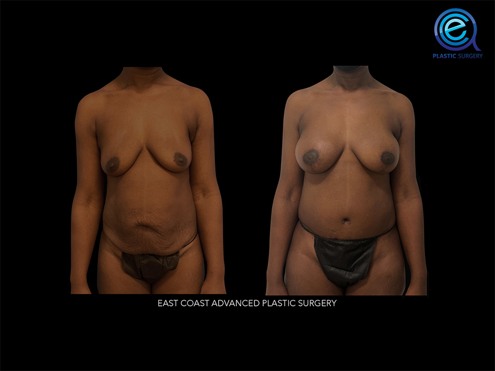 Real patient Breast Reconstruction by ECA Plastic Surgery, New Jersey