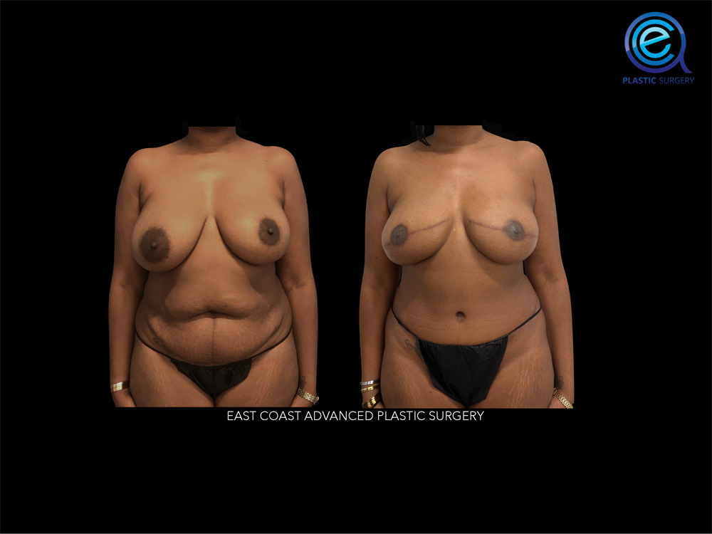 Real patient Breast Reconstruction by ECA Plastic Surgery, New Jersey
