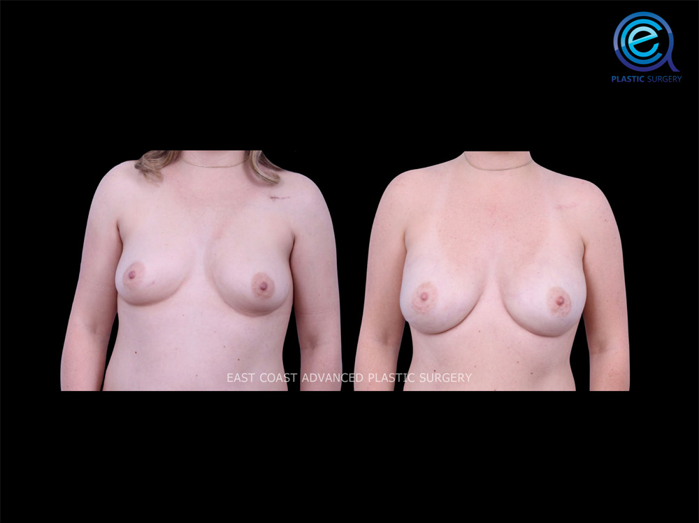 Real patient Breast Reconstruction by ECA Plastic Surgery, New Jersey