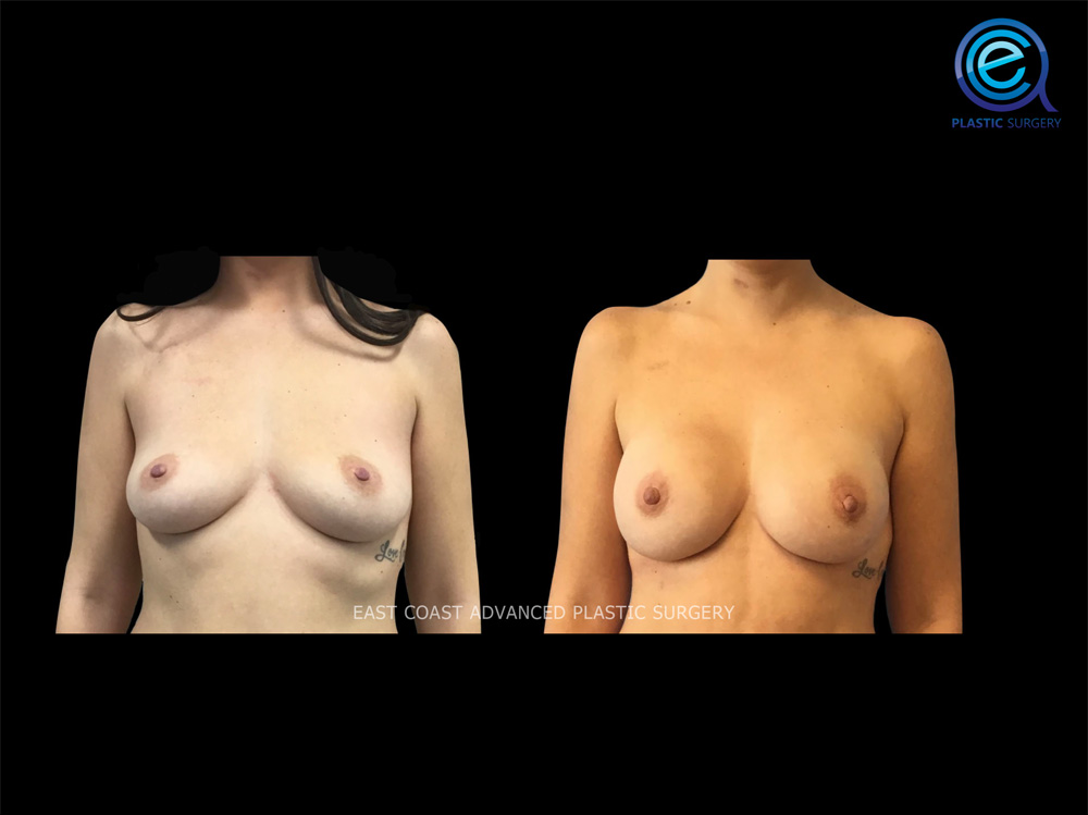 Real patient Breast Reconstruction by ECA Plastic Surgery, New Jersey