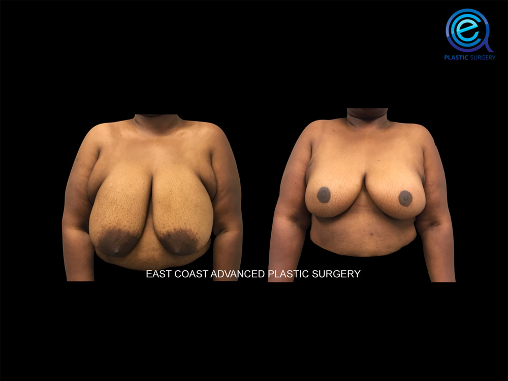 Real patient Breast Reconstruction by ECA Plastic Surgery, New Jersey