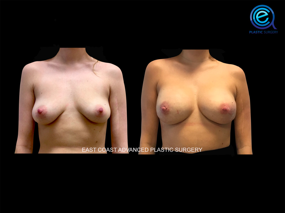 Real patient Breast Reconstruction by ECA Plastic Surgery, New Jersey